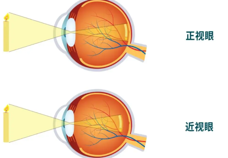 重庆叶剑和汪红做近视手术哪个好？专项技术擅长对比