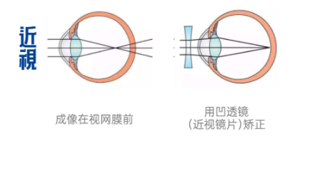 重庆叶剑和汪红做近视手术哪个好？真实患者口碑对比