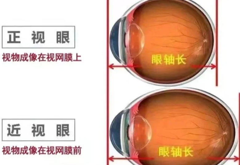 何氏和爱尔在青少年视力防控方面的实力对比