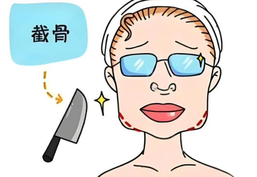 何照华磨骨靠谱吗？技术解析：张力带固定是关键，术后下垂风险低！术后下垂率控制在3%以内