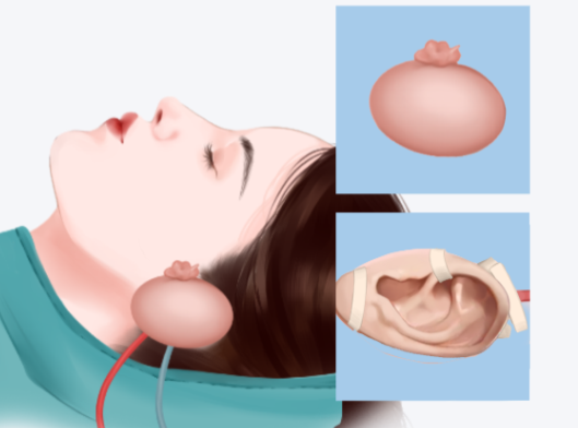 张正文教授技术靠谱吗？术后追踪耳朵轮廓清晰对称度高，数据说话：6000+案例后期不缩水
