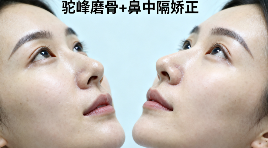 八大处范飞做鼻子价位全解析：全肋vs假体差价曝光，鼻综合4万起值不值？