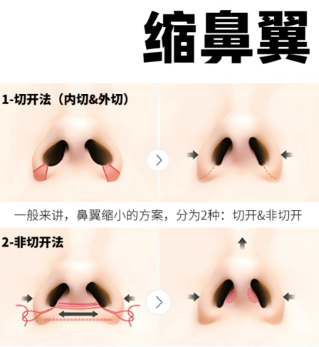深圳宝丽做隆鼻手术为何价格三万起？费用构成详解