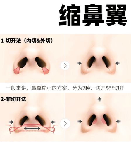 泰安鑫美星灿隆鼻效果真实反馈：肿胀轻好护理，鼻梁高挺不夸张
