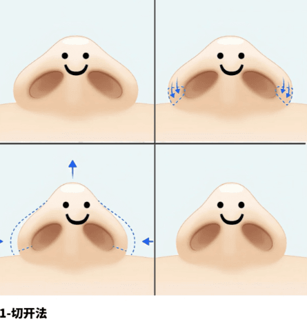 四、泰安鑫美星灿隆鼻效果在不同诉求下的反馈