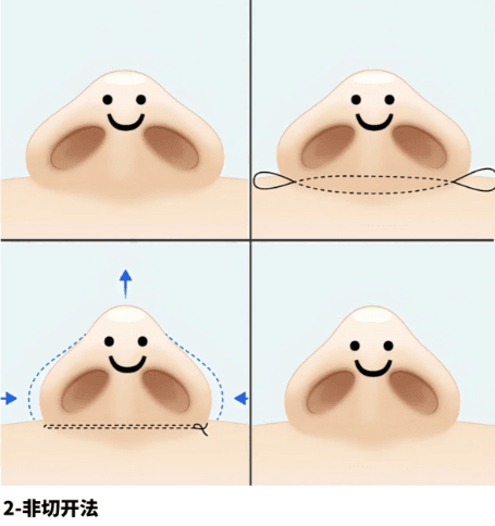 二、为什么泰安鑫美星灿隆鼻效果偏“妈生感”?技术拆开看