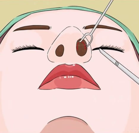 六、泰安鑫美星灿隆鼻效果常见问题